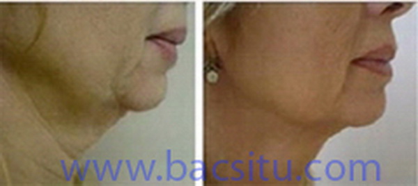 Thon gọn nọng và cạnh hàm