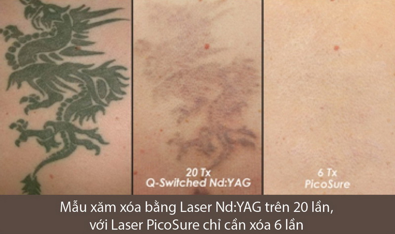 Chi Phí Xoá Xăm Hết Bao Nhiêu Tiền Giá Xoá Xăm Laser 2023