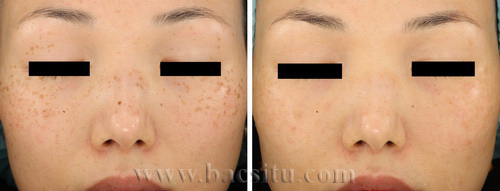 Xóa tàn nhang bằng Laser