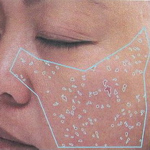 Thu hẹp lỗ chân lông cho da mịn màng