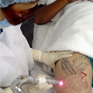 Xóa xăm bằng laser