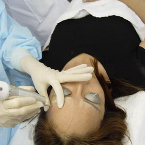 Xóa xăm mí mắt, xăm chân mày bằng Laser