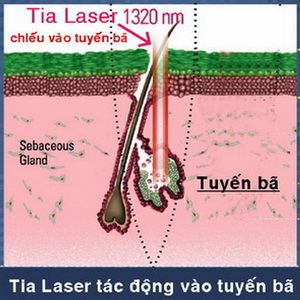 Công nghệ mới trị mụn trứng cá