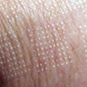 Phân hủy để tái tạo bề mặt da, xóa sẹo mụn, xóa nhăn...bằng Laser