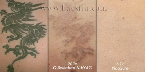 Mẫu xăm xóa bằng Laser Nd: YAG trên 20 lần,  với Laser PicoSure chỉ cần xóa 6 lần