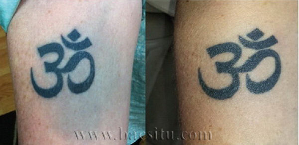 Xóa xăm lem màu bằng laser PicoSure