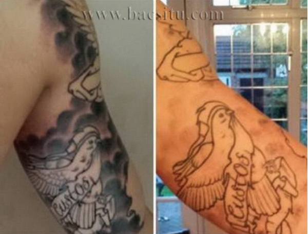 Trước & sau 1 lần xóa 1 phần hình xăm lem màu bằng Laser PicoSure