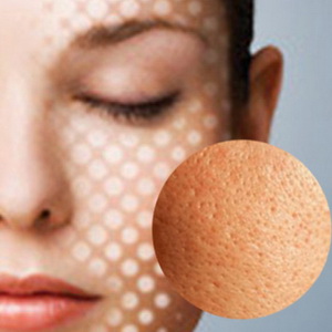 Thu nhỏ lỗ chân lông