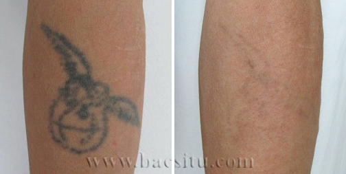 Xóa xăm bằng Laser Picosure