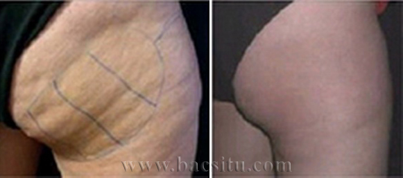 Thon gọn mông và đùi