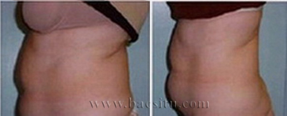 Thon gọn mông và đùi