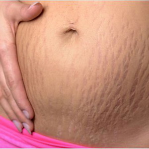 Hết rạn da mịn màng bằng Laser Icon