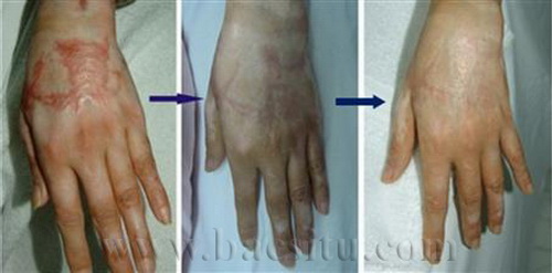 Sẹo lồi do phỏng: 6 tháng sau 6 lần điều trị bằng Laser Vbeam