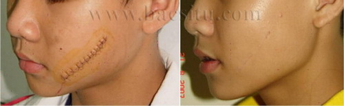 Điều trị sẹo bằng Laser