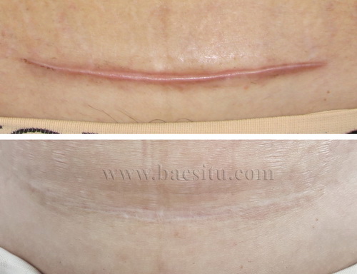 Điều trị sẹo lồi do mổ “bắt con” bằng Laser