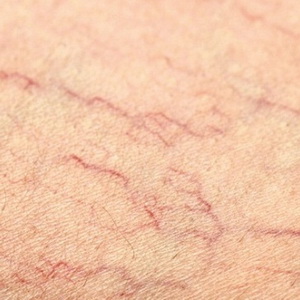 Xóa gân máu nổi trên da bằng Laser YAG và Vbeam