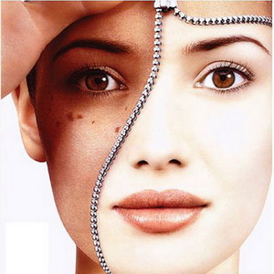 Trị nám da: chớ nôn nóng