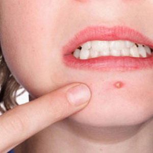 Rắc rối như… mụn