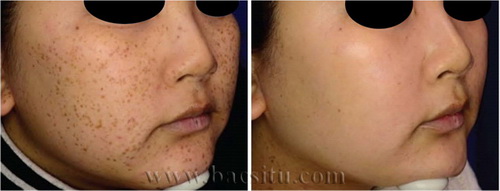 Xóa tàn nhang bằng Laser