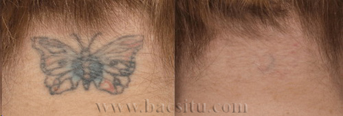 Xóa xăm bằng Laser PicoSure