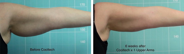 Thon gọn bắp tay