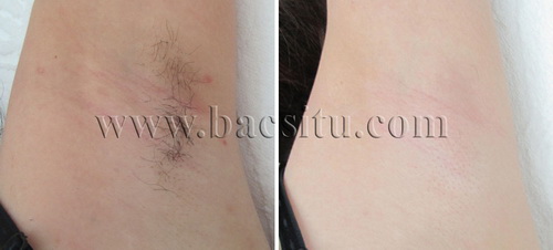 Triệt lông vùng nách