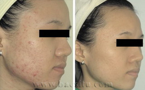 Điều trị mụn bằng Laser