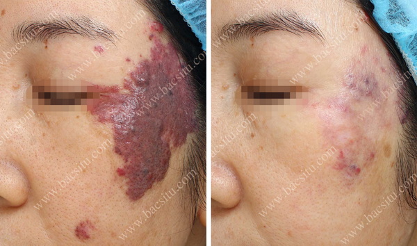 Xóa bớt đỏ bằng Laser