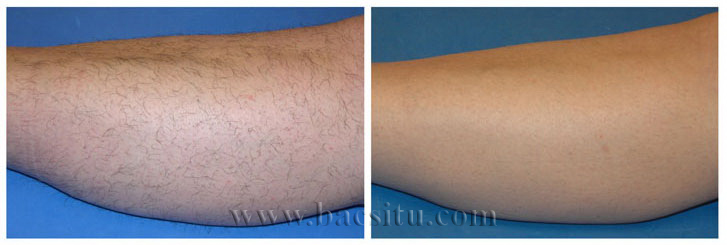 Triệt lông vùng chân