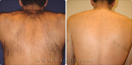 Triệt lông vùng lưng