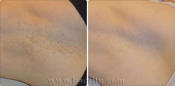 Triệt lông vùng nách