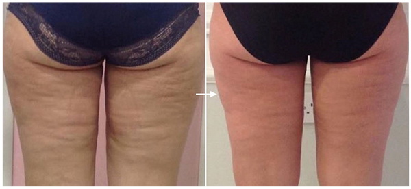 Săn chắc da & giảm cellulite