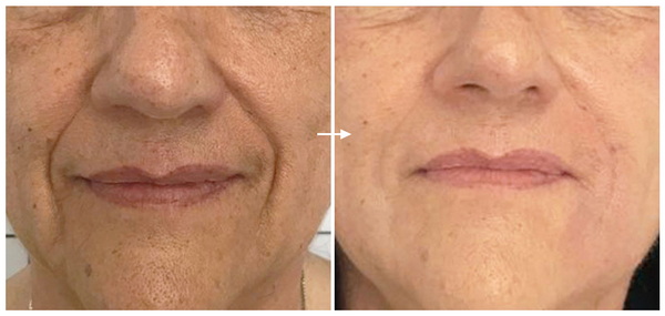 Săn da & giảm rảnh mũi má