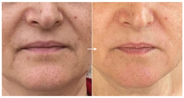 Săn da & giảm rảnh mũi má