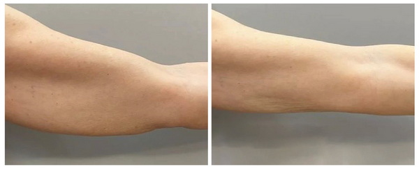 Thon gọn cánh tay