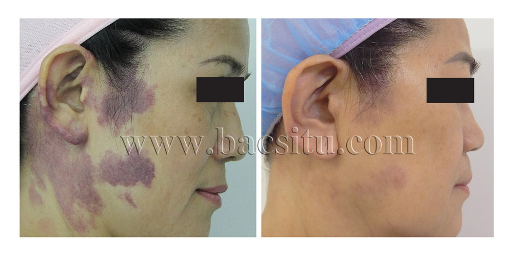 Xóa bớt đỏ bằng Laser