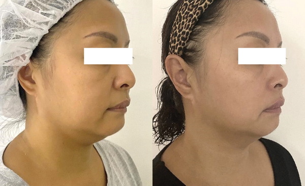 Thon gọn nọng & trẻ hóa gương mặt