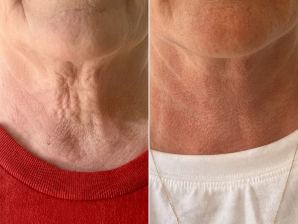 Trẻ hóa da vùng cổ