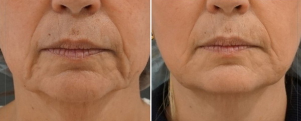 Săn da & giảm rãnh nhăn