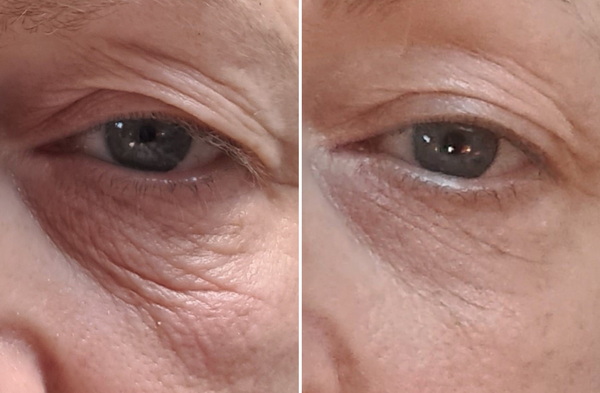 Trẻ hóa vùng mắt