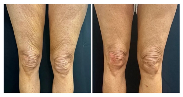 Săn da & trẻ hóa da