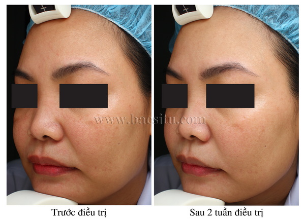 SÁNG DA & TRẺ HÓA DA