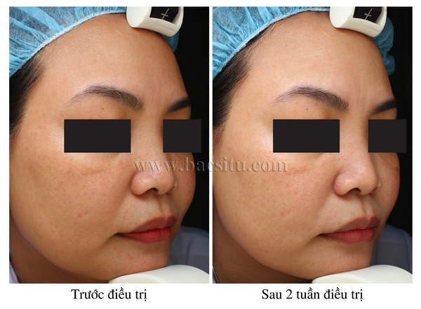 SÁNG DA & TRẺ HÓA DA