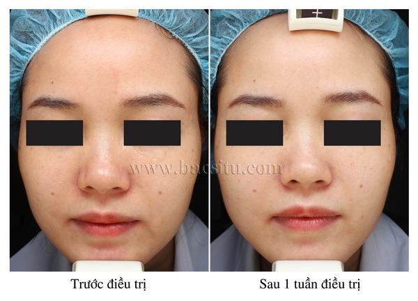 SÁNG DA & TRẺ HÓA DA