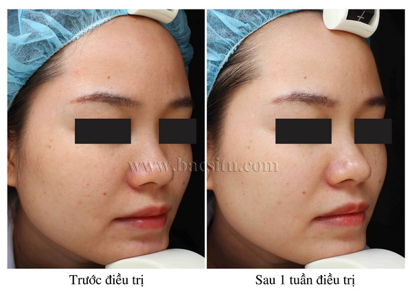 SÁNG DA & TRẺ HÓA DA