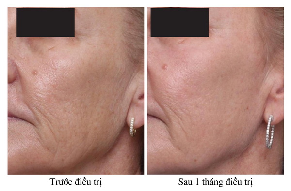 SÁNG DA & TRẺ HÓA DA