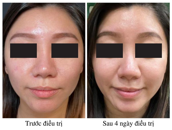 SÁNG DA & TRẺ HÓA DA