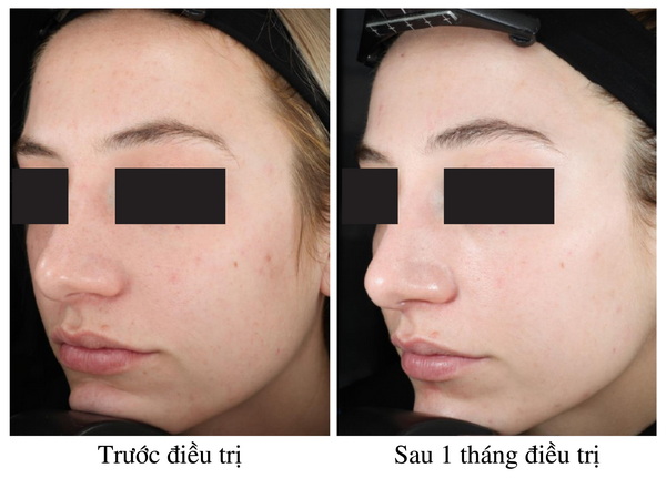 SÁNG DA & TRẺ HÓA DA