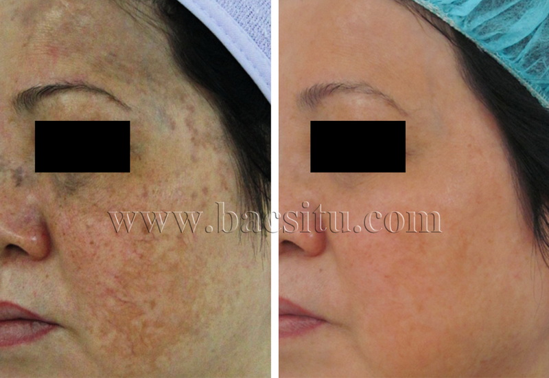 Điều trị nám và trẻ hóa da bằng Laser Pico